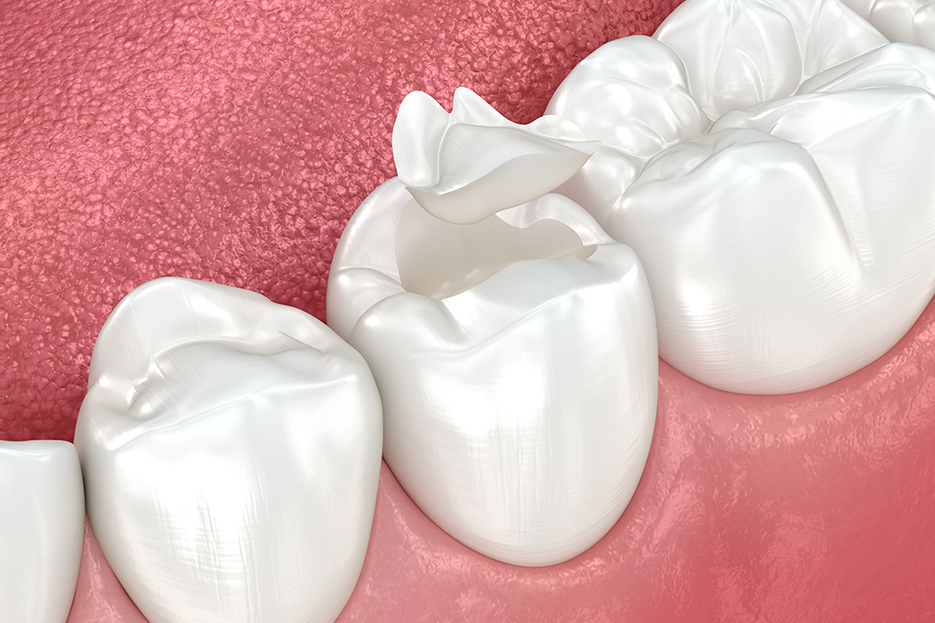 進行したむし歯の治療