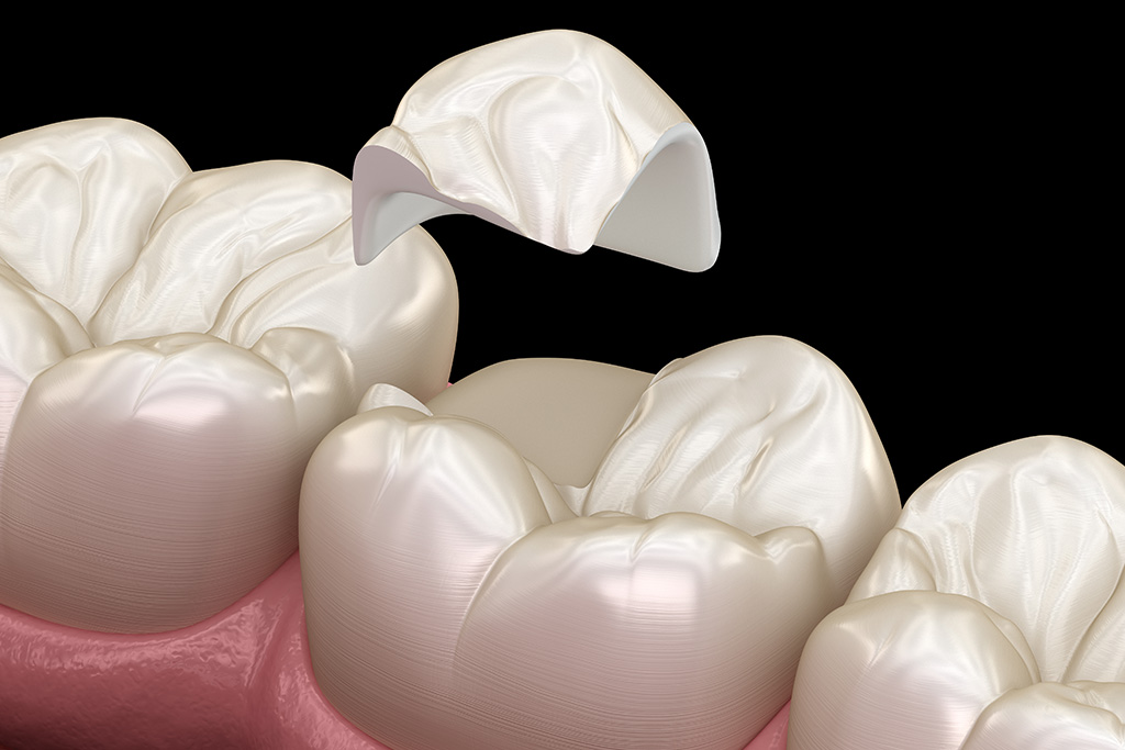 白い被せ物について