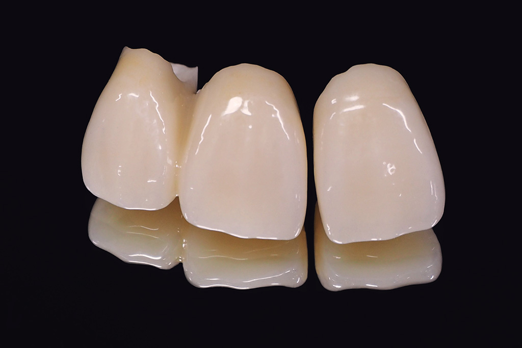 前歯の被せ物