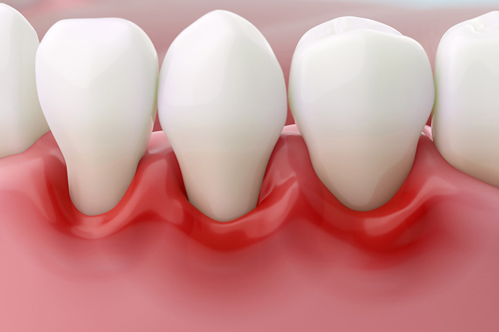 高瀬歯科の歯周病治療について